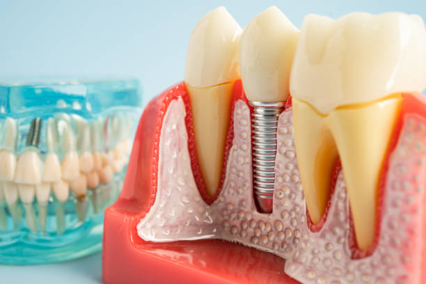 Best Wisdom Tooth Removal  in Falling Waters, WV